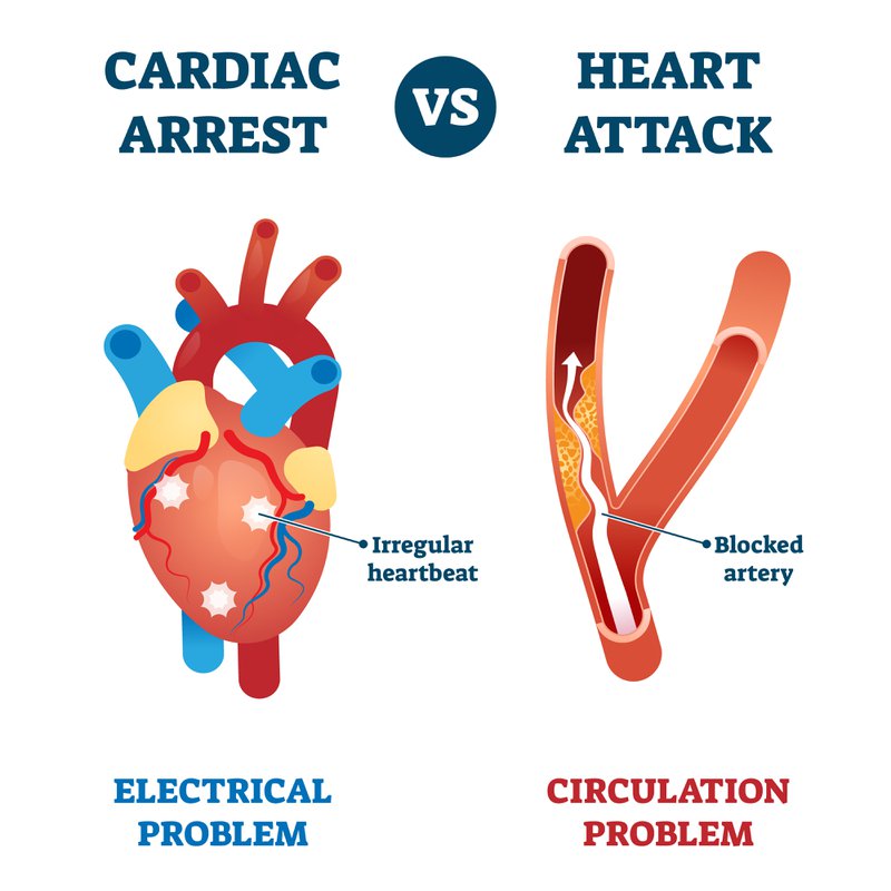 verschil tussen hartaanval en plots hartfalen